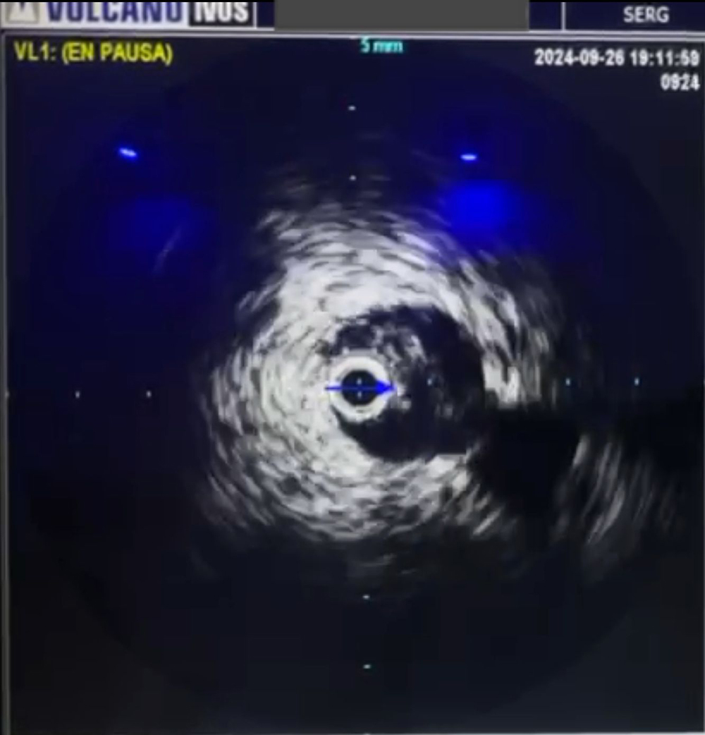 IVUS-1