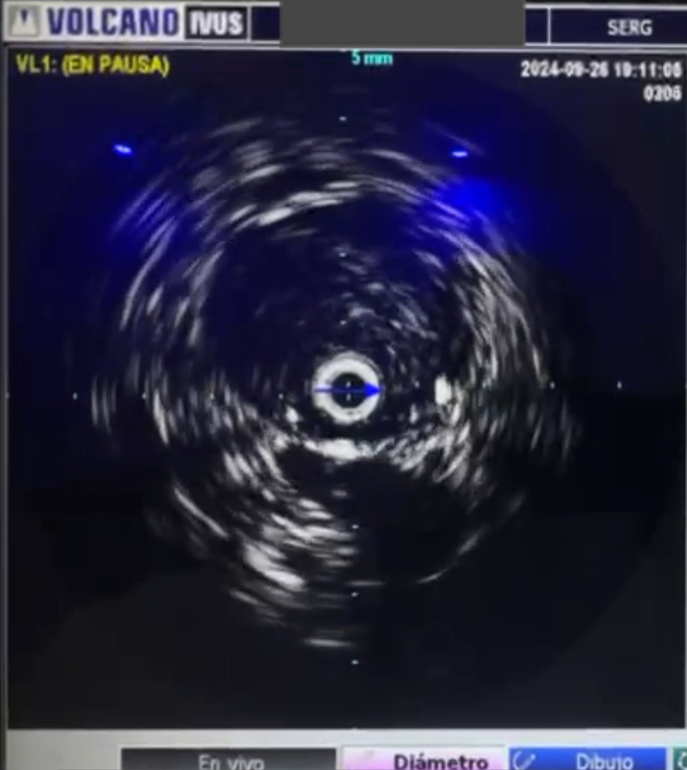 IVUS-CAVA