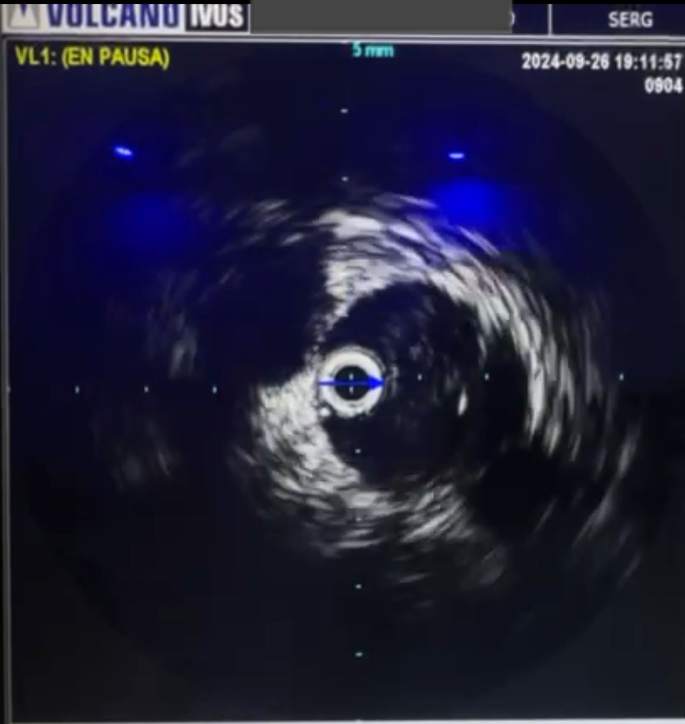 IVUS