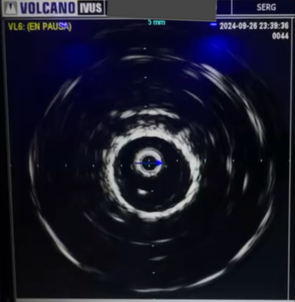 IVUS1