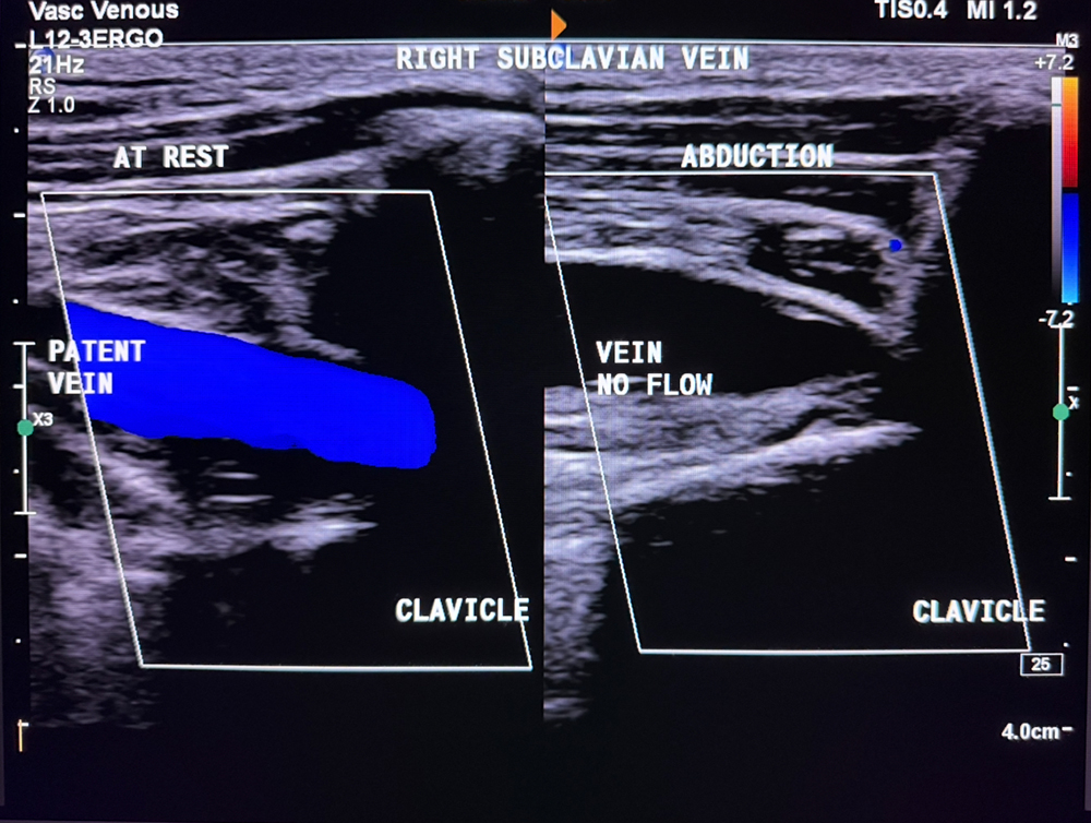 Subclavian-Vein_Previous-DVT_Pre_post-abduction