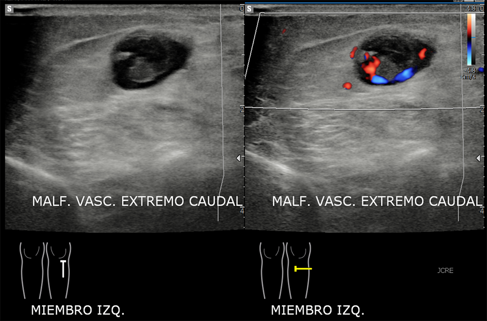 USG-MAV-post-embolization