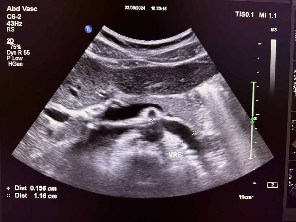 Veia-Renal-Esquerda